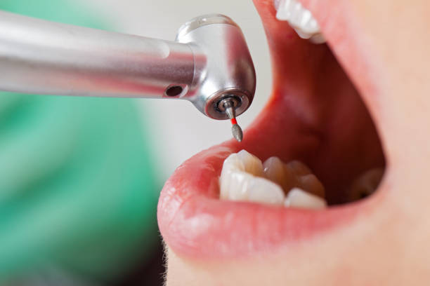 Best Emergency Root Canal Therapy in Auxvasse, MO